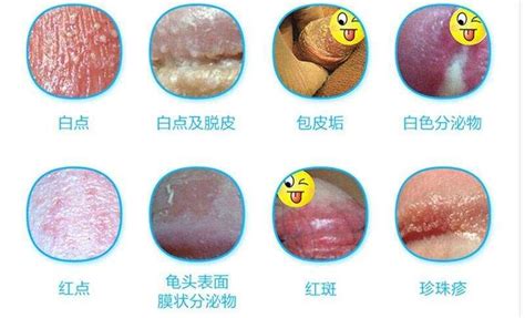 龜頭腫起來|黴菌性龜頭炎：症狀與處理